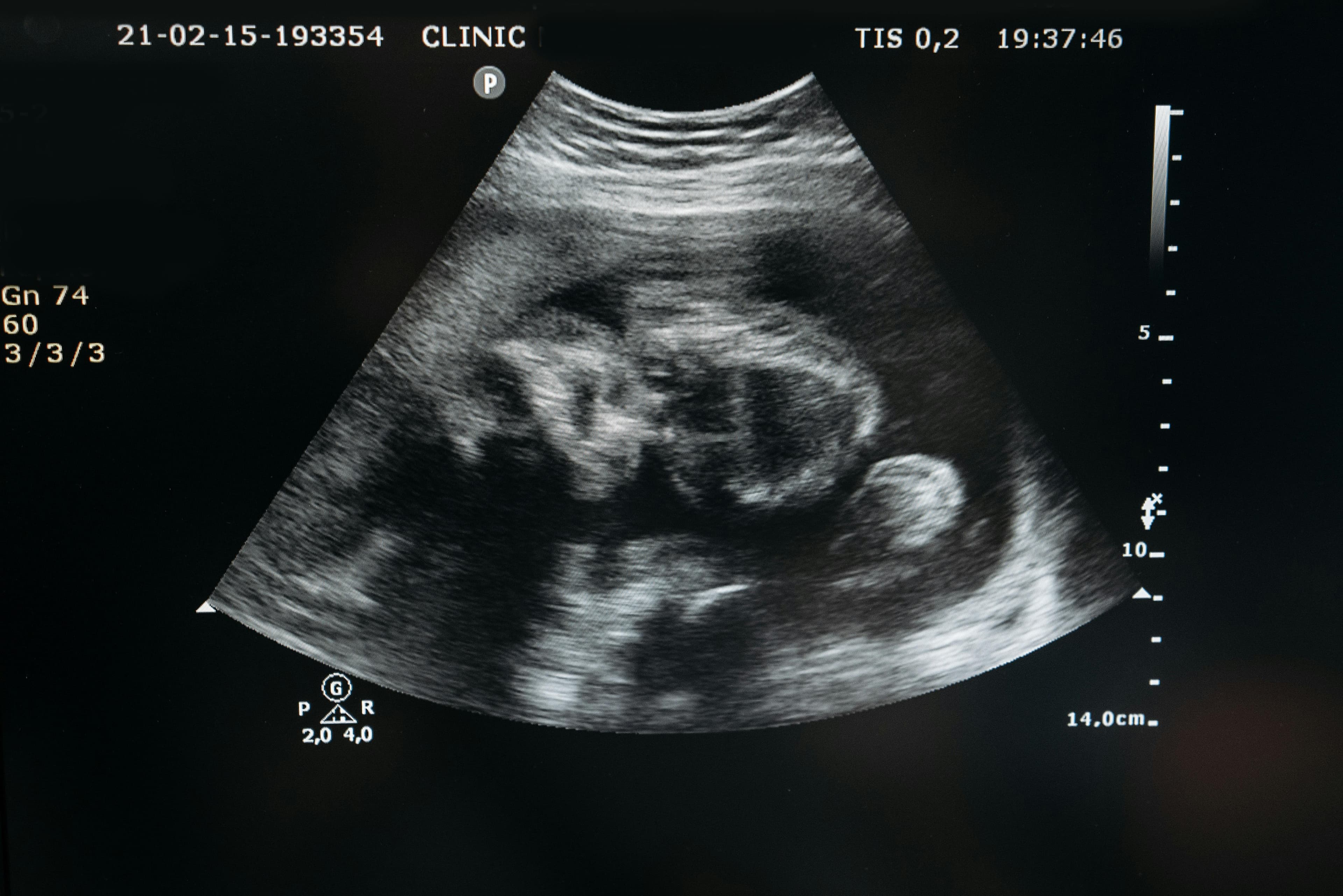 Ultrasound